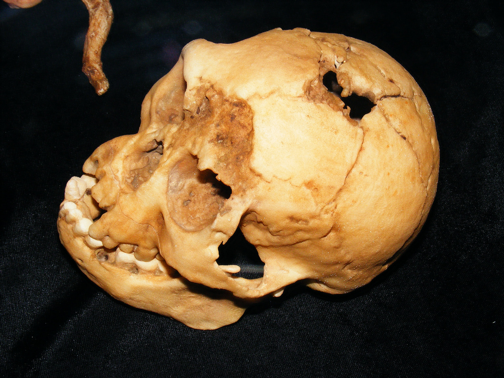 LB1 skull from Liang Bua (Flores): small braincase, short face, and matching mandible; the type specimen for Homo floresiensis.