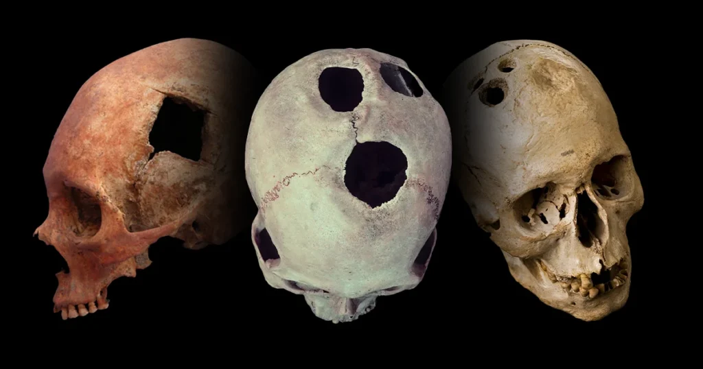 Ancient Skull Surgery